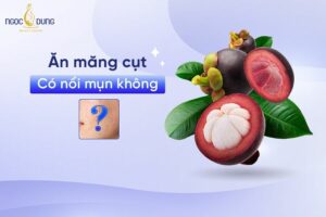 Ăn măng cụt có nổi mụn không? Hãy cùng chuyên gia Ngọc Dung tìm hiểu ngay