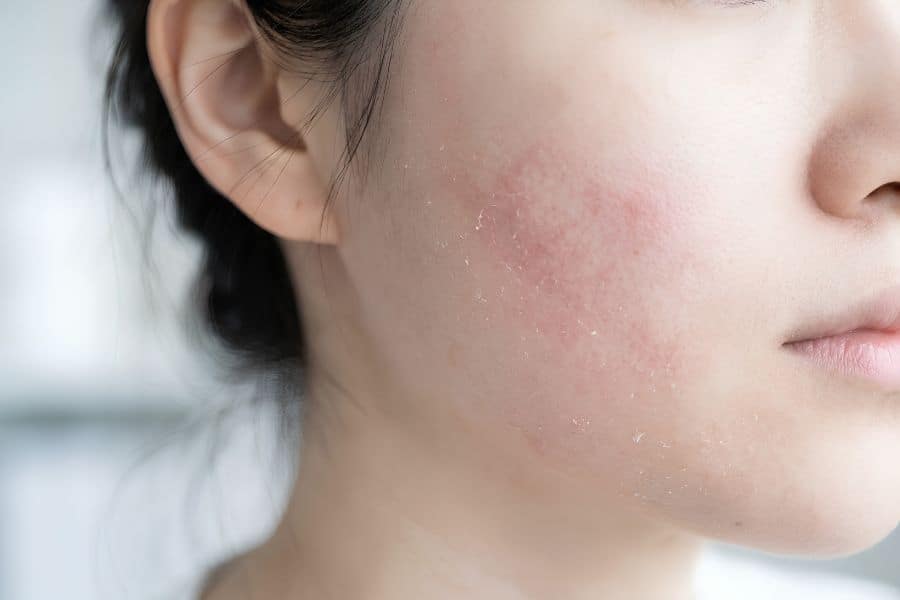Ngưng sử dụng rượu thuốc ngay khi da xuất hiện dấu hiệu bất thường
