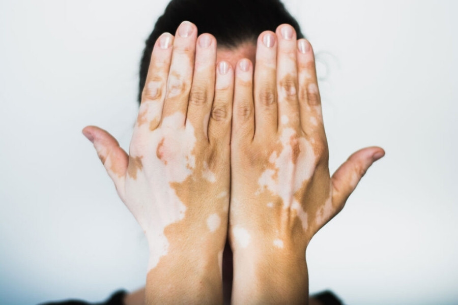 Mất sắc tố da có thể tạo ra hiện tượng loang lổ trên da