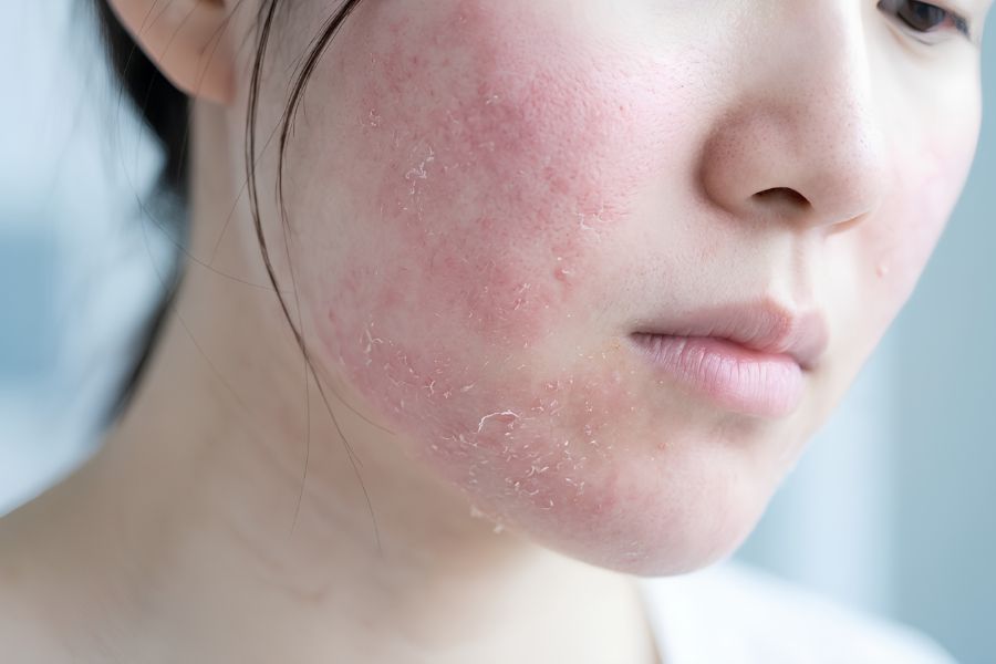 Da đỏ rát, bong tróc có thể là dấu hiệu kích ứng rượu thuốc 