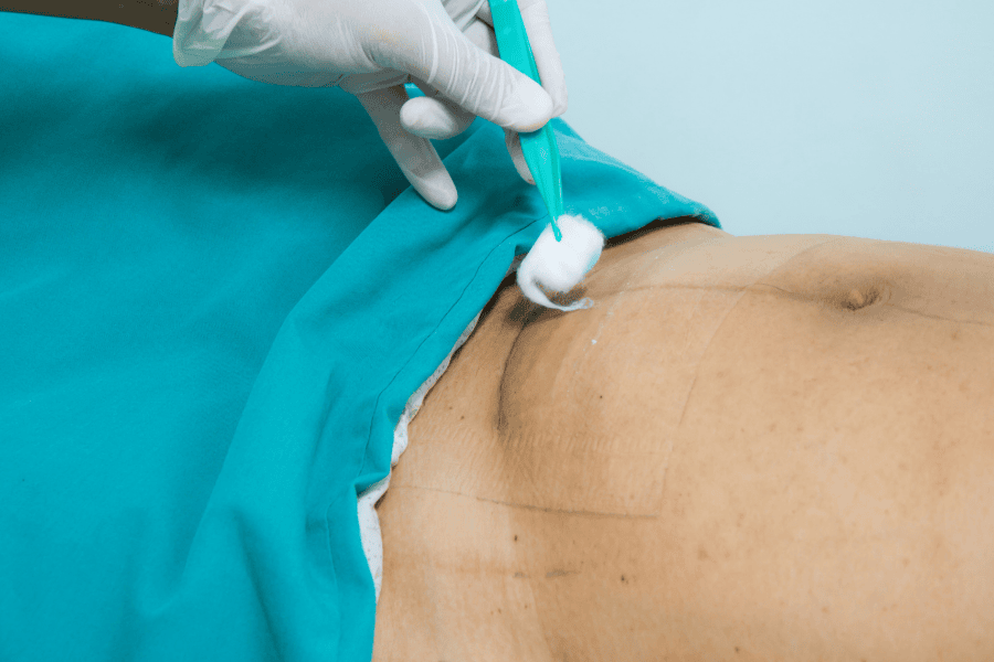 Làm sạch vết mổ đẻ để tránh bị nhiễm trùng và biến chứng