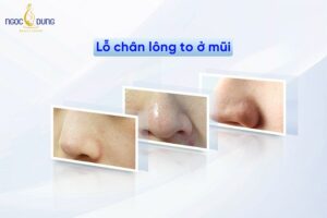 “Mách” ngay các cách trị lỗ chân lông to ở mũi hiệu quả không phải ai cũng biết