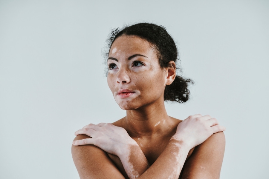Tình trạng viêm da có thể dẫn đến sự thay đổi sắc tố da