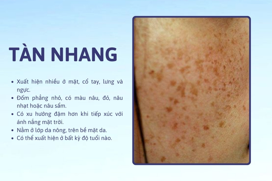 Tàn nhang thường xuất hiện trên lớp da nông, tại bề mặt da
