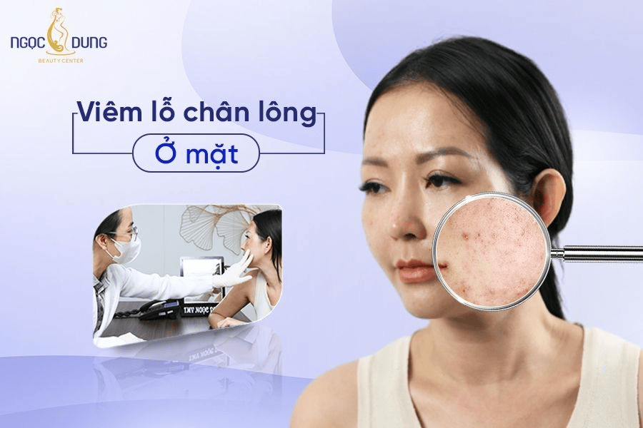 Nguyên nhân, dấu hiệu và cách điều trị viêm lỗ chân lông ở mặt hiệu quả