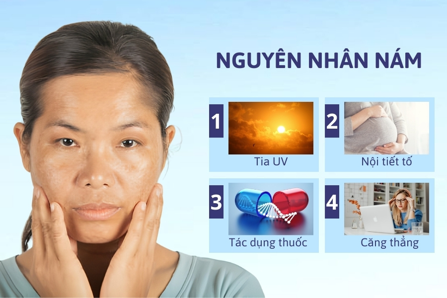Nguyên nhân gây nám da bao gồm ánh nắng mặt trời, nội tiết tố, tác dụng của thuốc, stress kéo dài