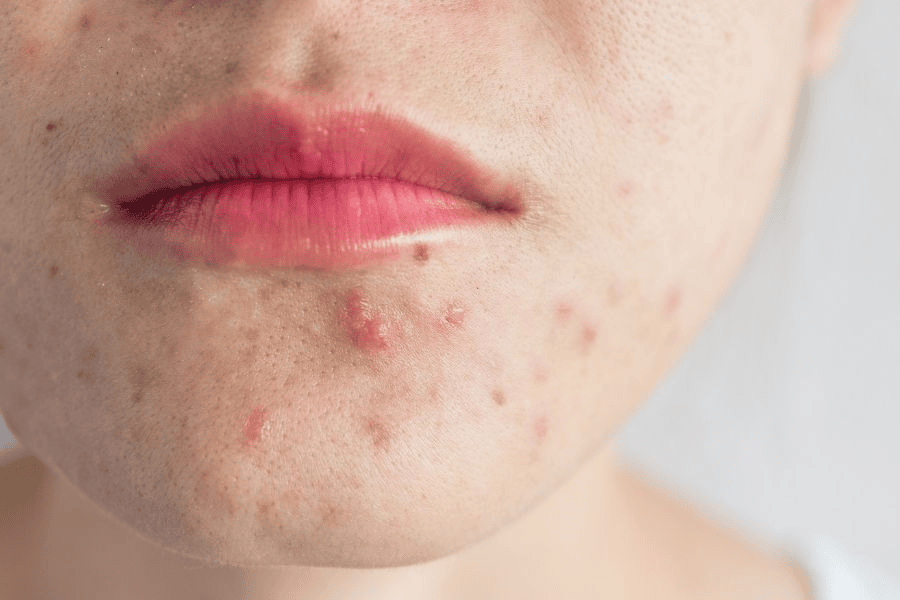 Những dấu hiệu bị viêm lỗ chân lông ở mặt thường gặp