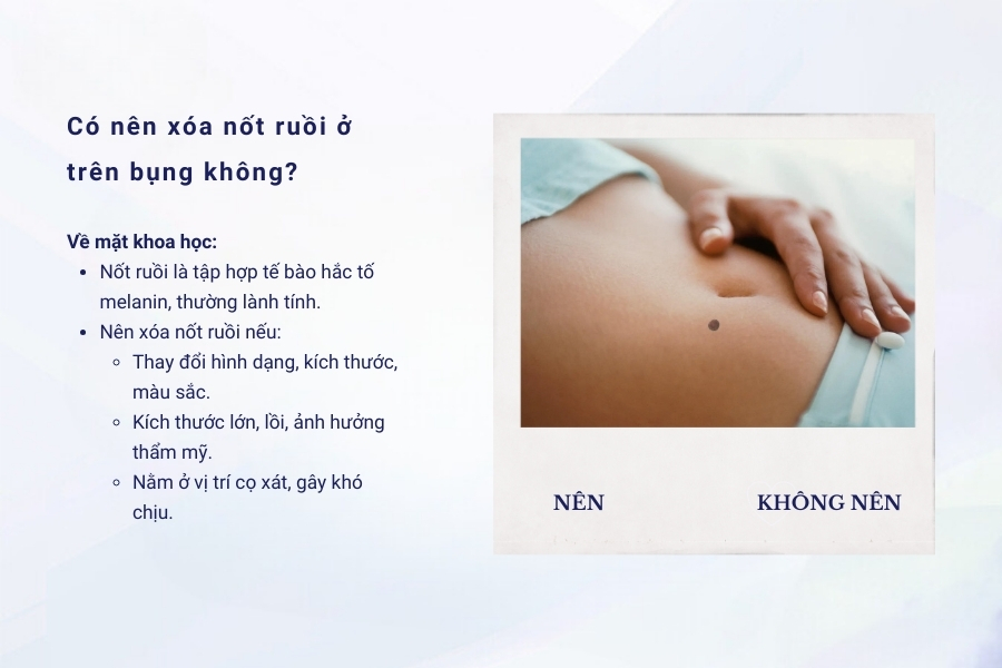 Nốt ruồi trên bụng là tốt hay xấu? Có nên xóa hay không?