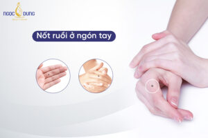 Giải mã nốt ruồi ở ngón tay: Hé lộ bí mật về con người bạn