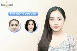Nốt ruồi ở sơn căn là điềm xấu hay điềm tốt? Cùng chuyên gia Ngọc Dung Beauty tìm hiểu ngay