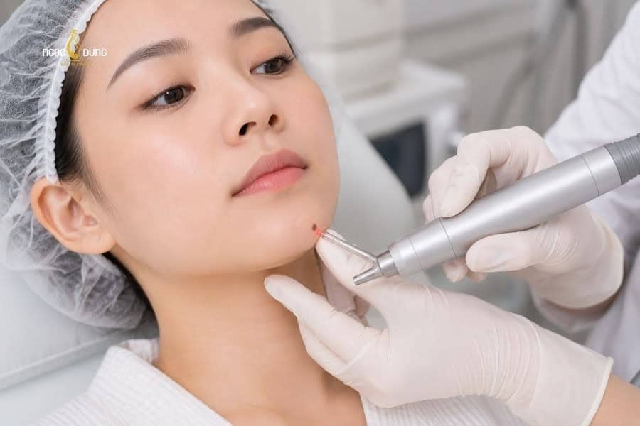 Nốt ruồi ở cằm mang ý nghĩa gì? Giải mã tướng số nam nữ 11 Ngọc Dung mang đến giải pháp tẩy nốt ruồi an toàn và hiệu quả nhanh chóng