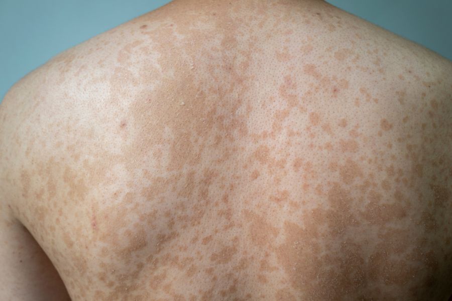 Bệnh lang băng có thể khiến làn da xuất hiện các đốm sắc tố da