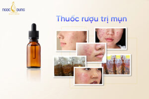 Thuốc rượu trị mụn: Tác hại khôn lường ẩn sau lời quảng cáo