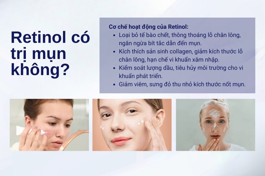 Retinol có trị mụn không? Dùng Retinol trị mụn như thế nào?