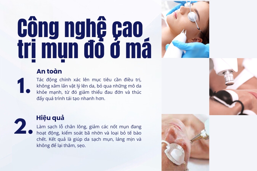 Điều trị mụn thâm đỏ ở má bằng liệu pháp công nghệ cao