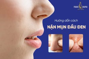 Giải đáp thắc mắc: Có nên nặn mụn đầu đen tại nhà không? 