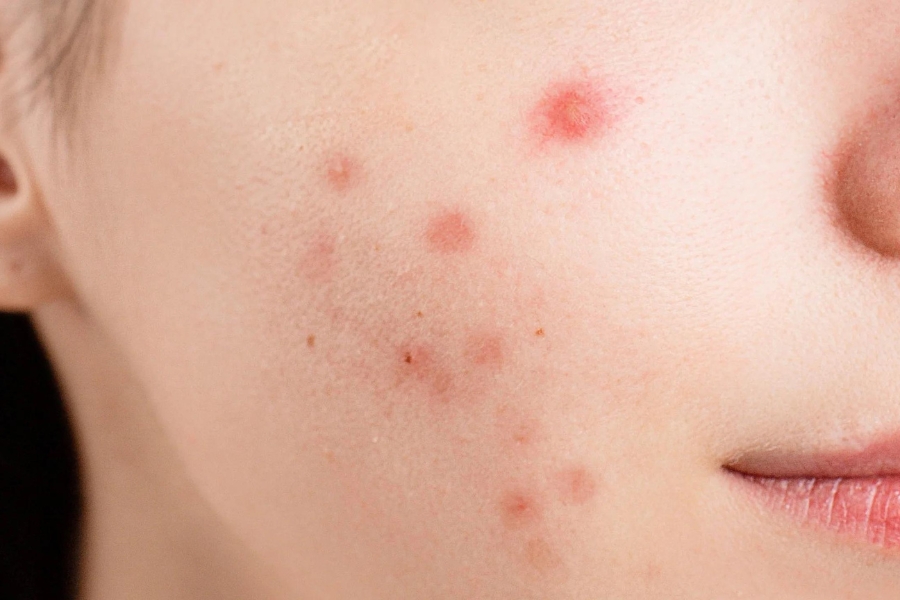 Vi khuẩn P.Acnes gây mụn đỏ hai bên má