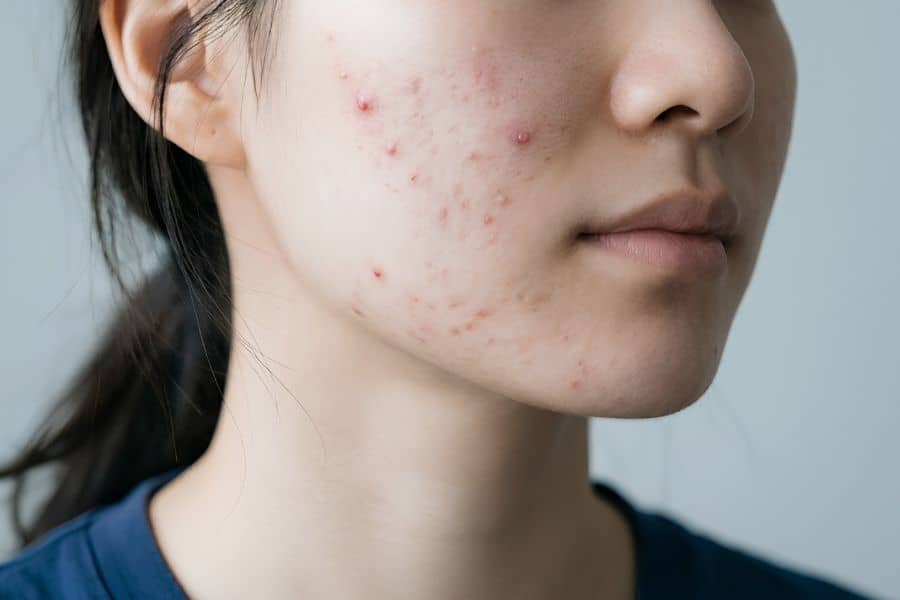 Da đang viêm nhiễm hoặc có vết thương hở cần được thông báo trước khi soi 
