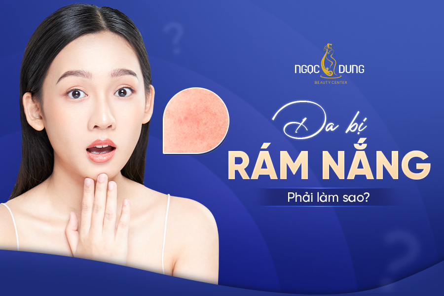 Da rám nắng