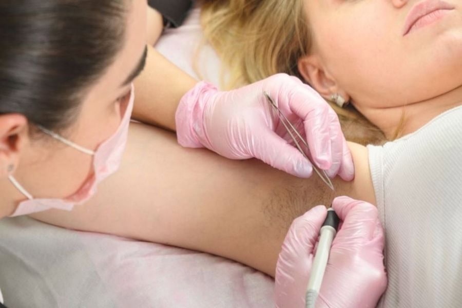 Bôi gì để lông không mọc lại? Bí kíp giúp da mịn màng 14 Điện phân là phương pháp tác động trực tiếp vào từng nang lông bằng dòng điện