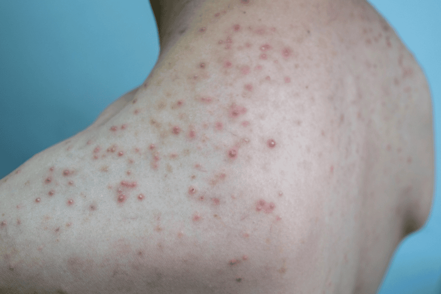 Khi tuyến bã nhờn tăng tiết quá mức, dầu thừa tích tụ trong lỗ chân lông tạo môi trường thuận lợi cho vi khuẩn phát triển