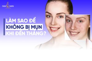 Góc giải đáp: Làm sao để không bị mụn khi đến tháng?