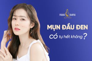 Mụn đầu đen có tự hết được không? Cùng chuyên gia tại Ngọc Dung tìm hiểu ngay