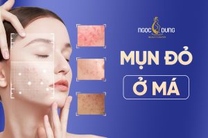 Bị nổi mụn đỏ ở má: Nguyên nhân và cách điều trị hiệu quả