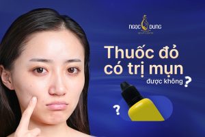 Povidine thuốc đỏ có trị mụn được không? Có tốt không?