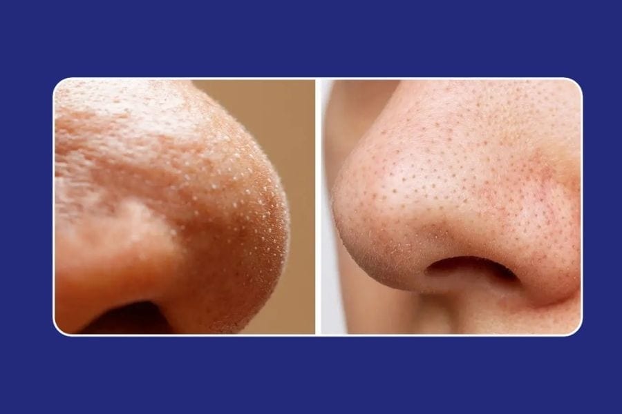 Mụn cám là gì? Nguyên nhân, dấu hiệu và cách trị tốt 4 Vùng mũi là khu vực dễ thấy mụn cám nhất vì mật độ tuyến bã nhờn cao hơn các vùng khác trên mặt