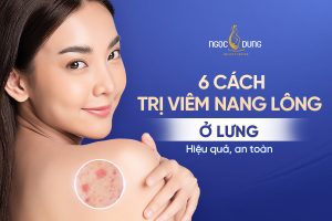 Viêm nang lông lưng