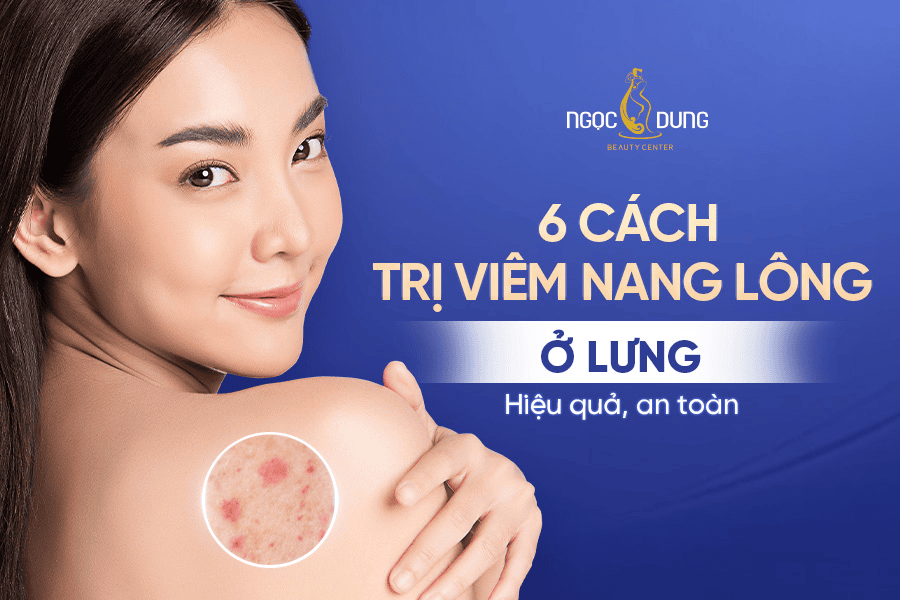 Những cách trị viêm nang lông ở lưng hiệu quả và an toàn