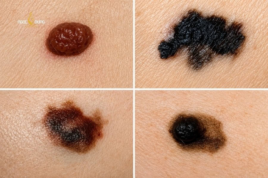 Nốt ruồi ở ngực nói lên điều gì về số mệnh? Tốt hay xấu 17 Hãy khi thăm khám khi phát hiện thấy các nốt ruồi bất thường