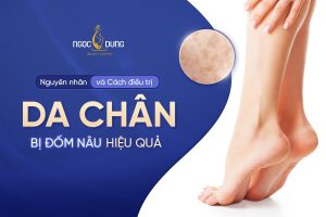 Nguyên nhân và cách điều trị da chân bị đốm nâu hiệu quả