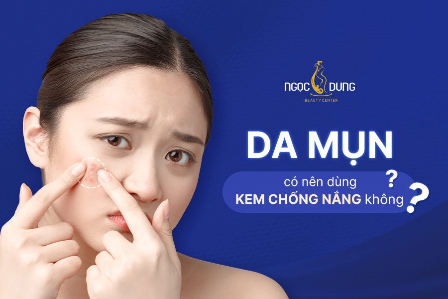 Góc giải đáp: Da mụn có nên dùng kem chống nắng không?