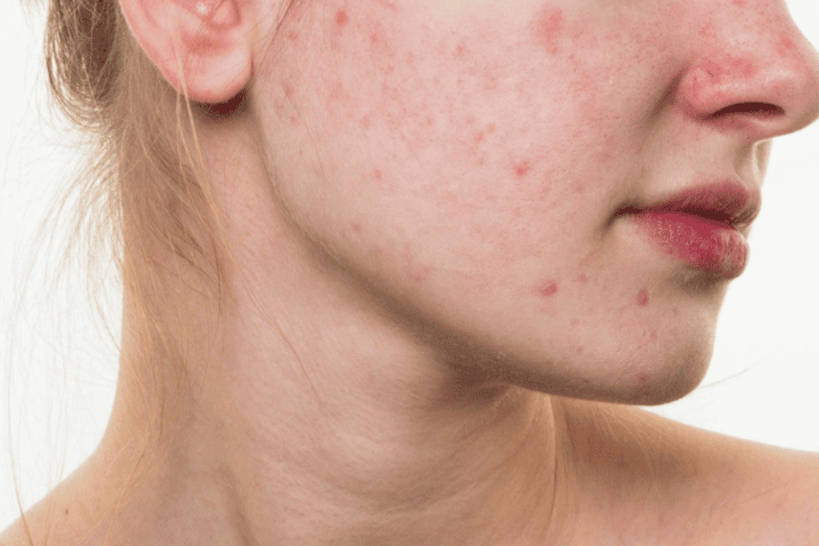 Hạn chế tẩy da chết khi tình trạng da đang viêm nặng