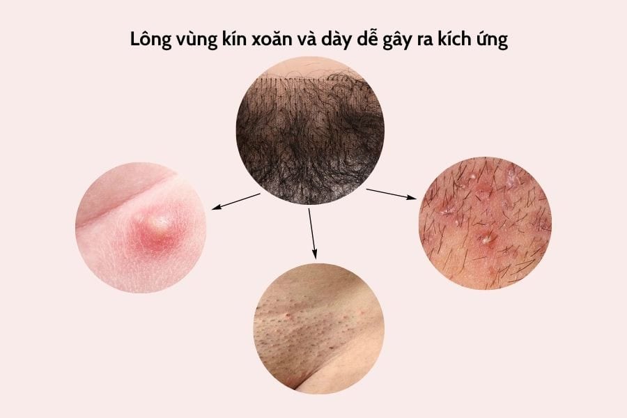 Lông vùng kín cứng và xoăn dễ ảnh hưởng đến sức khỏe vùng kín