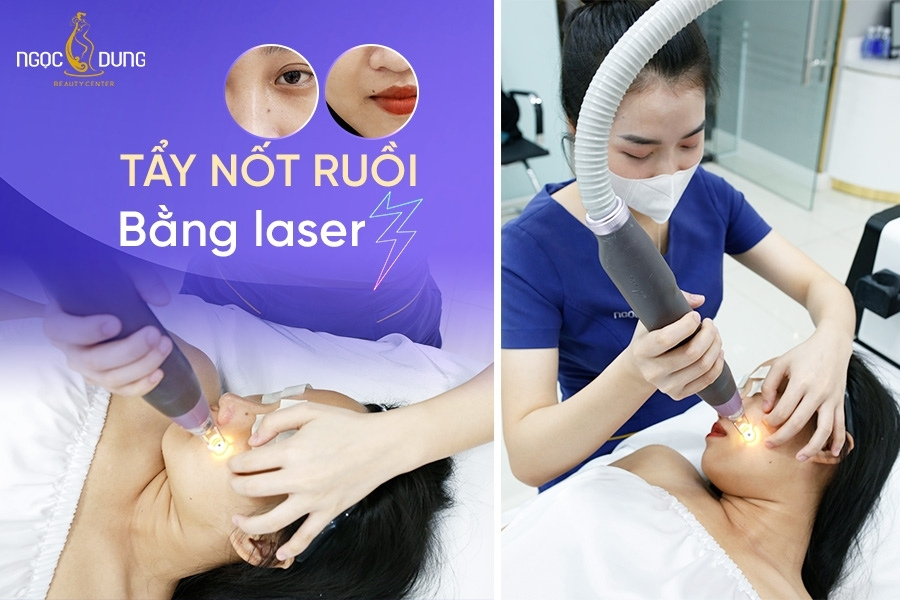 Nốt ruồi ở nhân trung kích thước lớn có nên xóa bỏ