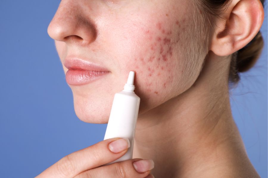 Các loại kem trị mụn có chứa thành phần như axit salicylic, benzoyl peroxide giúp kháng khuẩn, giảm viêm