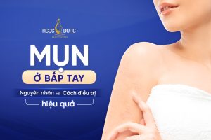 Mụn bắp tay là do đâu? Nguyên nhân và cách điều trị tại nhà