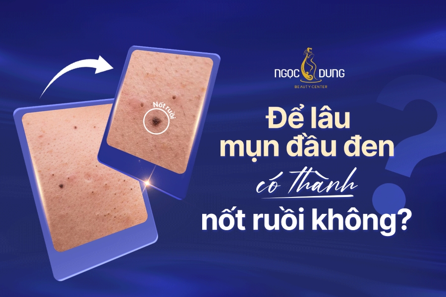 Để lâu không nặn mụn đầu đen có thành nốt ruồi không?