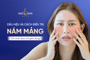 Nám mảng là gì? Nguyên nhân, cách điều trị nám mảng tốt nhất