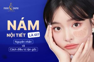 Nám nội tiết là gì? Nguyên nhân và cách điều trị nám da do nội tiết