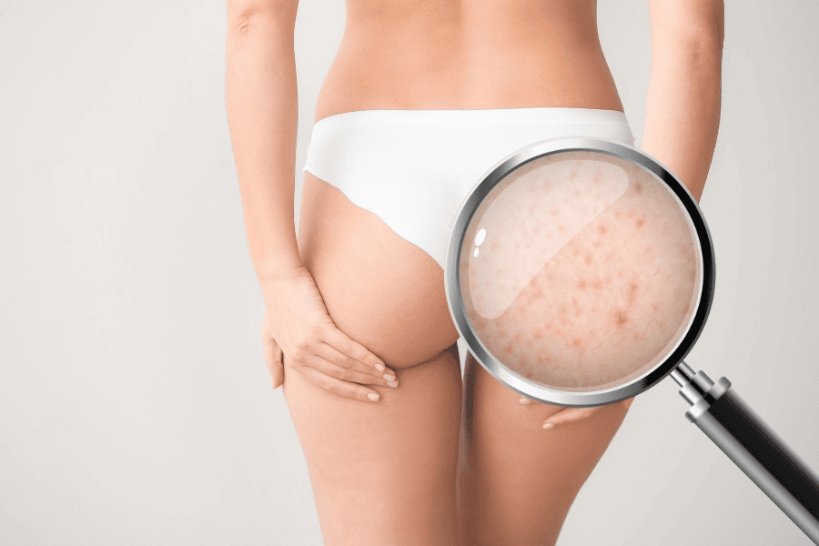 Những dấu hiệu bị viêm nang lông 