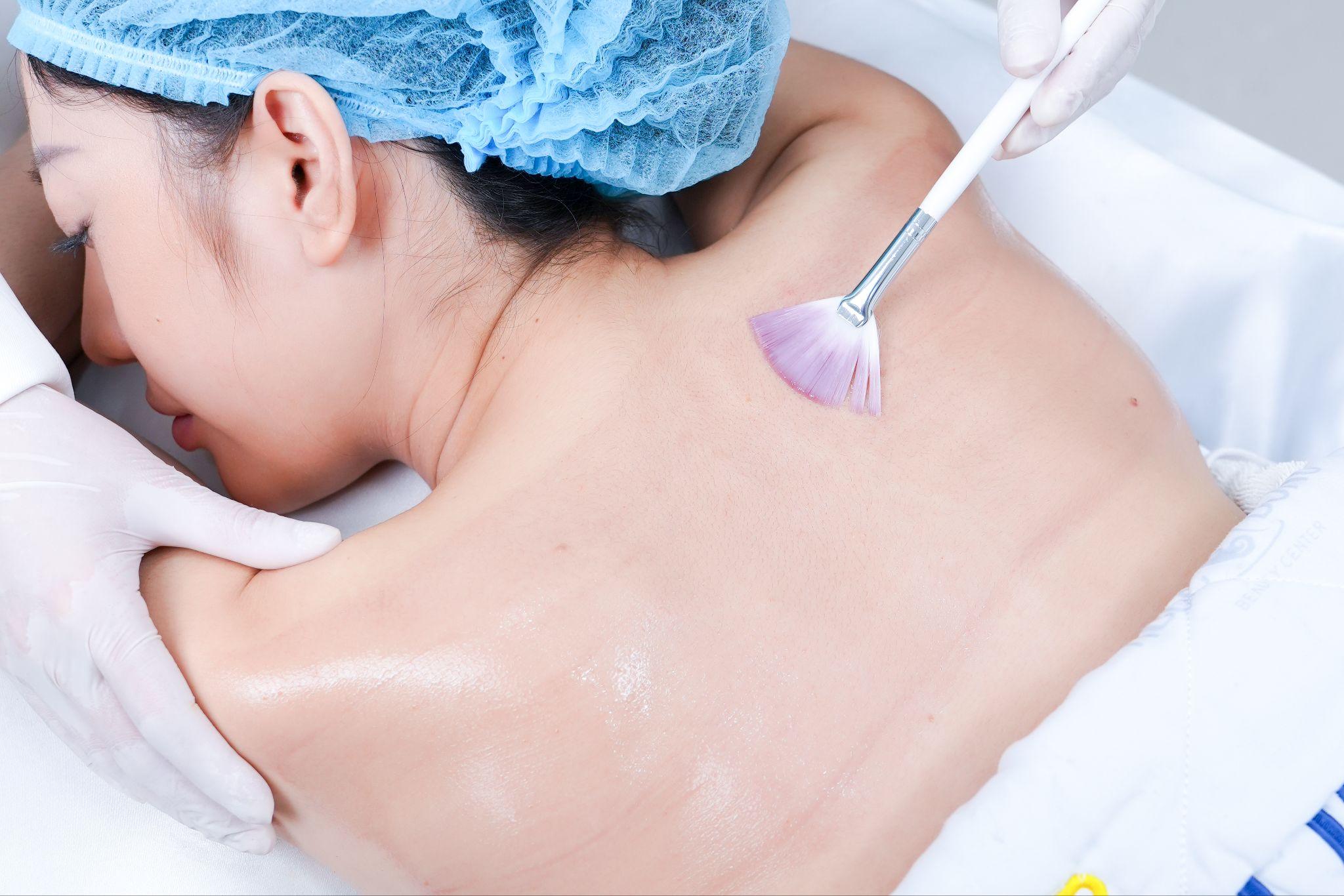 Những ưu điểm khi thực hiện TCA peel tại TMV Ngọc Dung