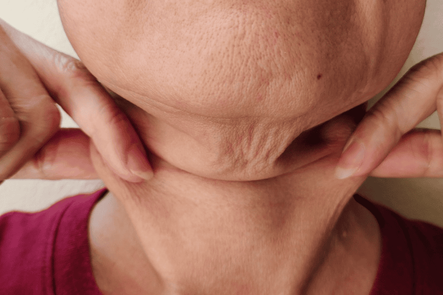 Da chảy xệ chùng nhão: Nguyên nhân và giải pháp khắc phục 3 Những vị trí thường xuất hiện chùng nhão như vùng mặt, cổ, bụng,...