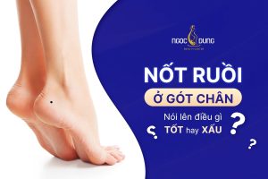 Ý nghĩa nốt ruồi ở gót chân: Cuộc đời giàu sang hay nghèo khổ