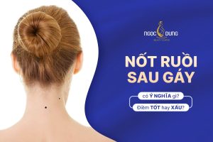 Nốt ruồi sau gáy nam, nữ có ý nghĩa gì? Phước hay là họa?
