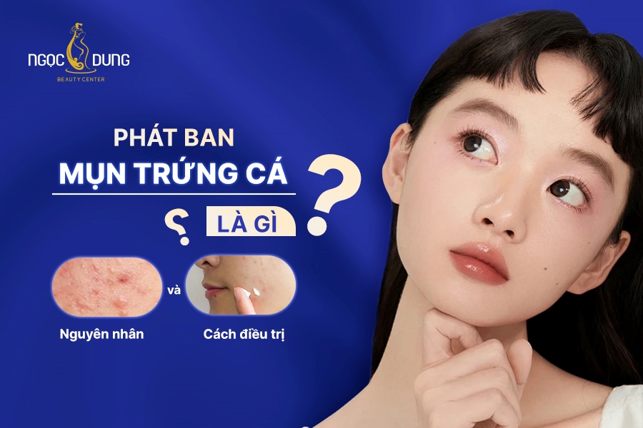 Phát ban mụn trứng cá là gì? Nguyên nhân và cách điều trị