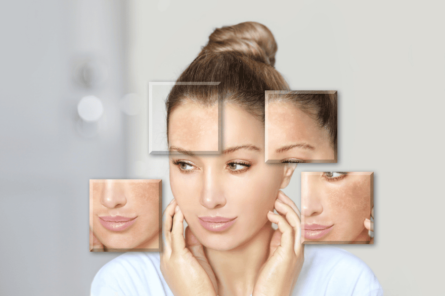 TCA peel phá vỡ cấu trúc tế bào chứa melanin dư thừa tại lớp biểu bì, điều trị nám và tăng sắc tố hiệu quả